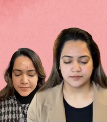 Chemical Peel before and after