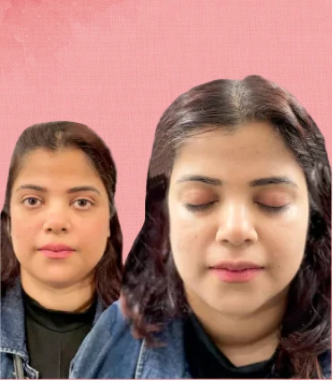 Chemical Peel before and after