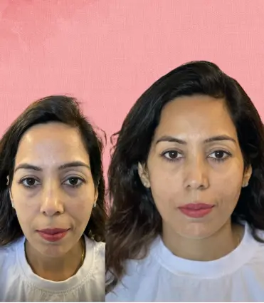 Facial Contouring Therapy before and after