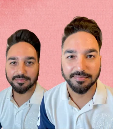 Hydrafacial before and after
