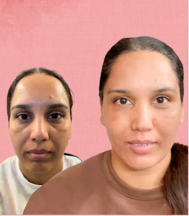 Under Eye & Cheek Filler before and after