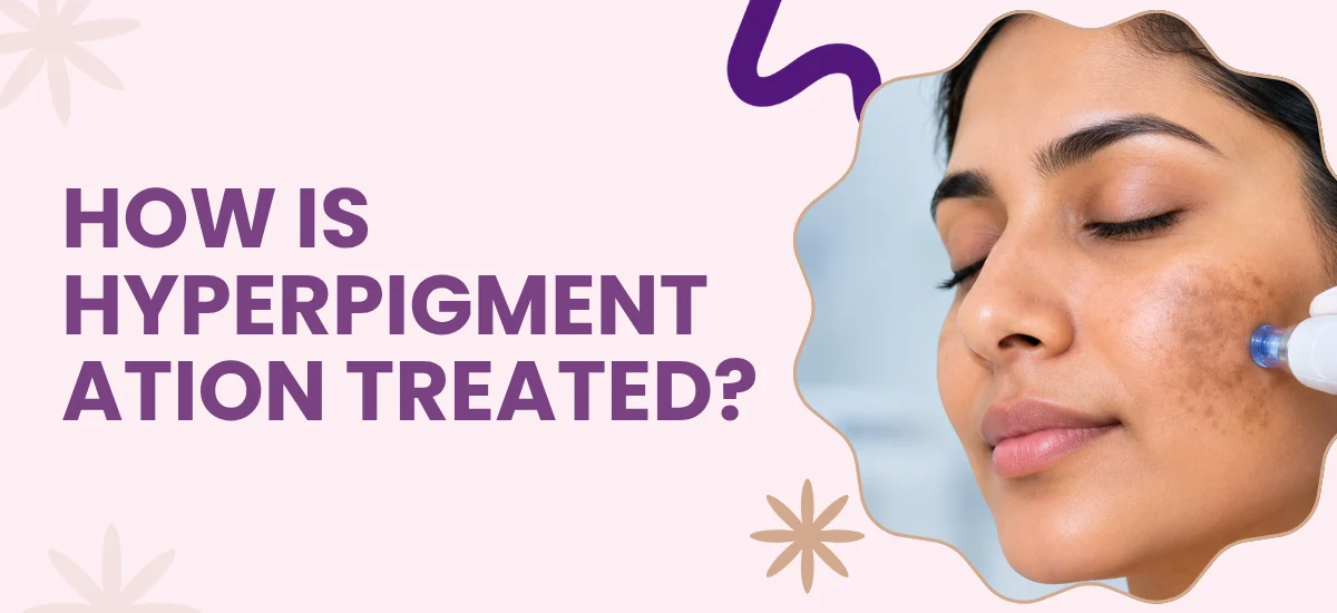 How Is Hyperpigmentation Treated?