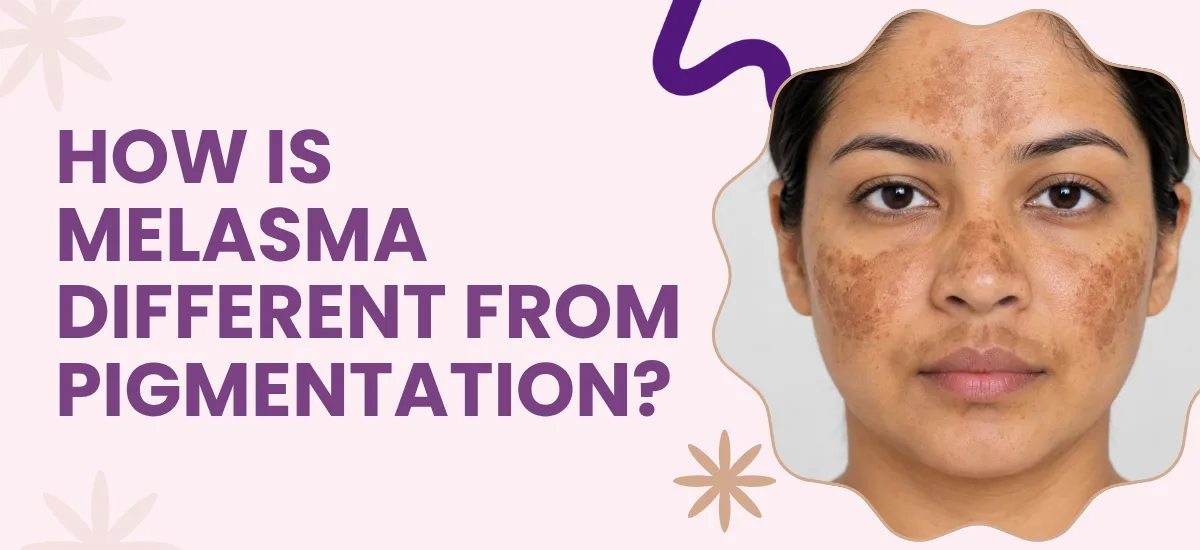 How Is Melasma Different From Pigmentation?